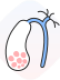 gallstone (1)